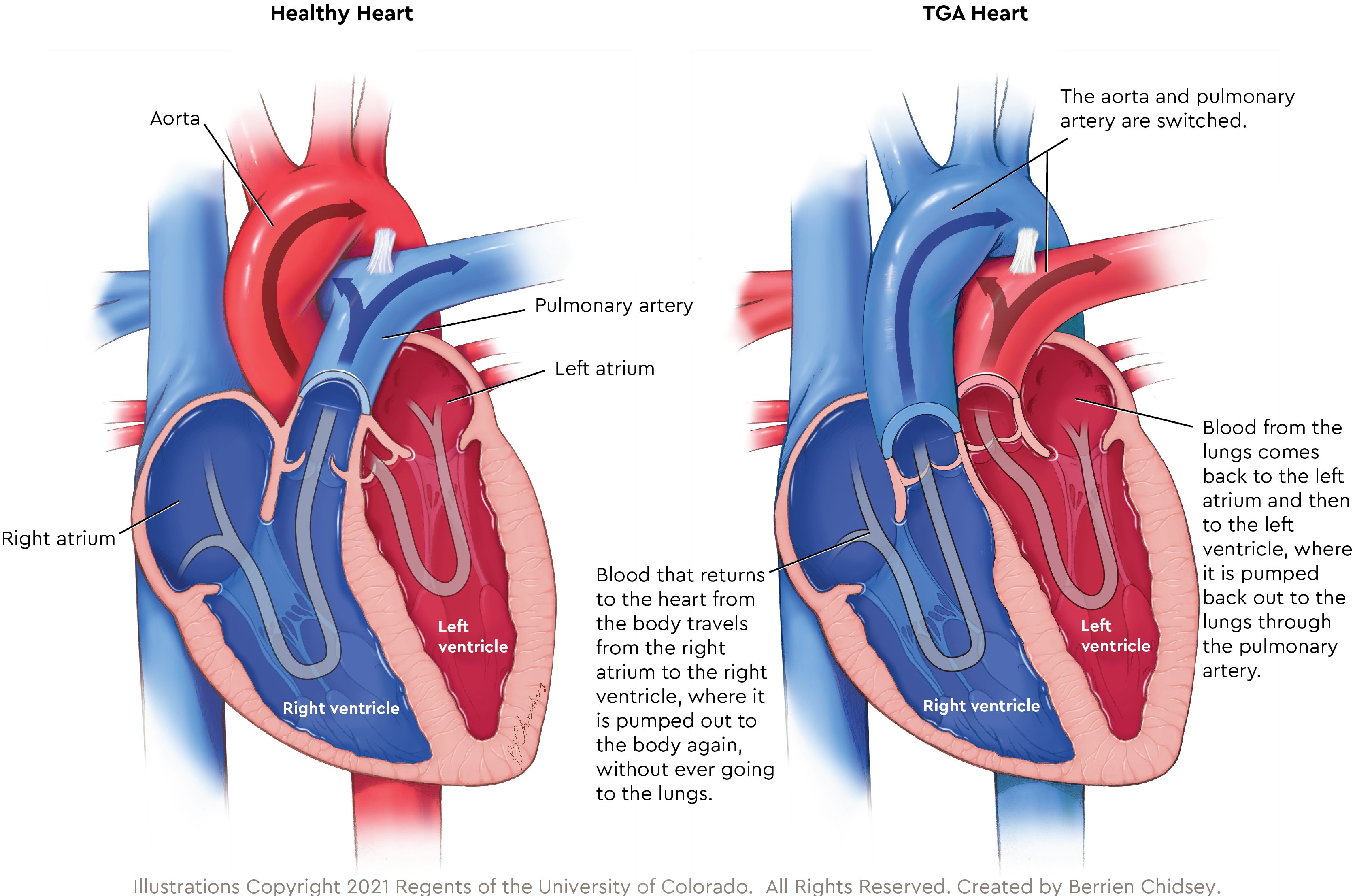 Healthy vs TGA anatomy_v1-02.jpg