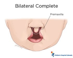 An artist's drawing of the bottom half of a baby's face. The upper lip extends up to the nose and there is a line to it that says Premaxilla.