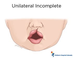 An artist's drawing of the bottom half of a baby's face. The upper lip extends only part of the way up to the nose on the right side only.