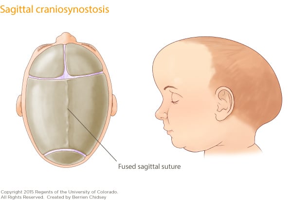 An illustration of a baby's skull with the plates fused across the middle and labeled Fused sagittal suture. Next to it is an illustration of a baby's head showing the irregular shape elongating out toward the back.