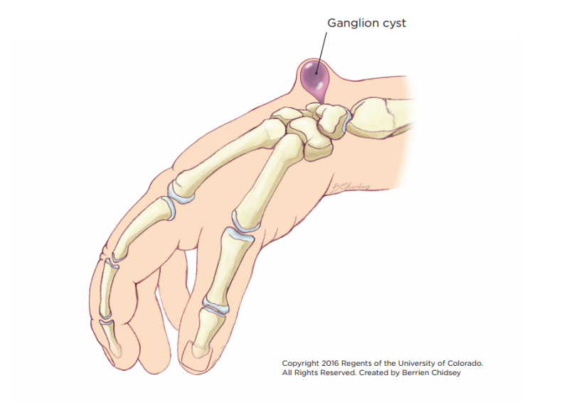 An illustration of a hand showing the bones inside and a purple balloon shaped lump on the wrist identified as a ganglion cyst.