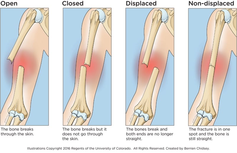 An illustration showing an open fracture that breaks through the skin, a closed fracture that happens when the bone breaks but doesn't go through the skin, a displaced fracture that happens when the bones breaks and the ends are no longer straight, and a non-displaced fracture that happens when the fracture is in one spot and the bone is still straight.