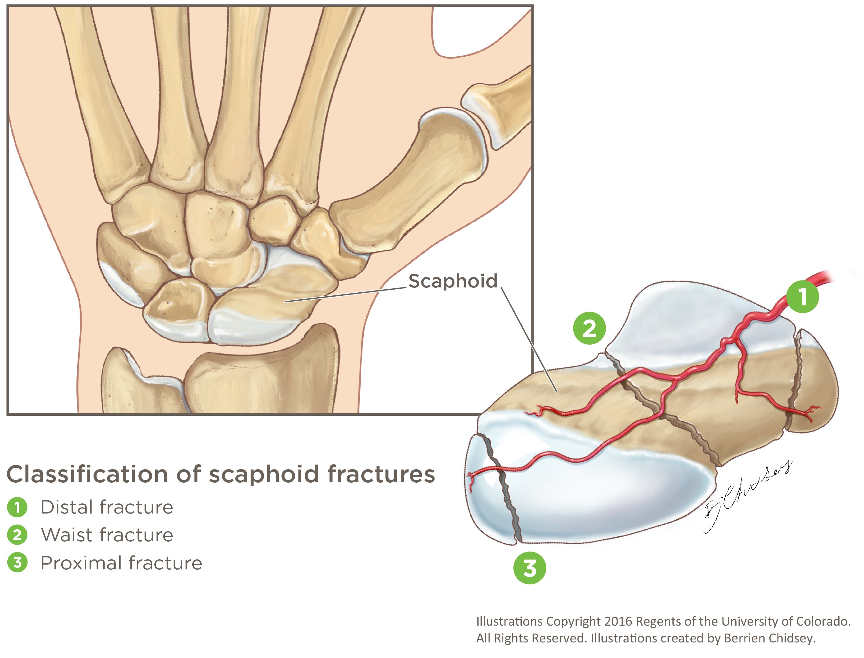 A graphic illustration of three types of scaphoid fractures: distal, waist and proximal.