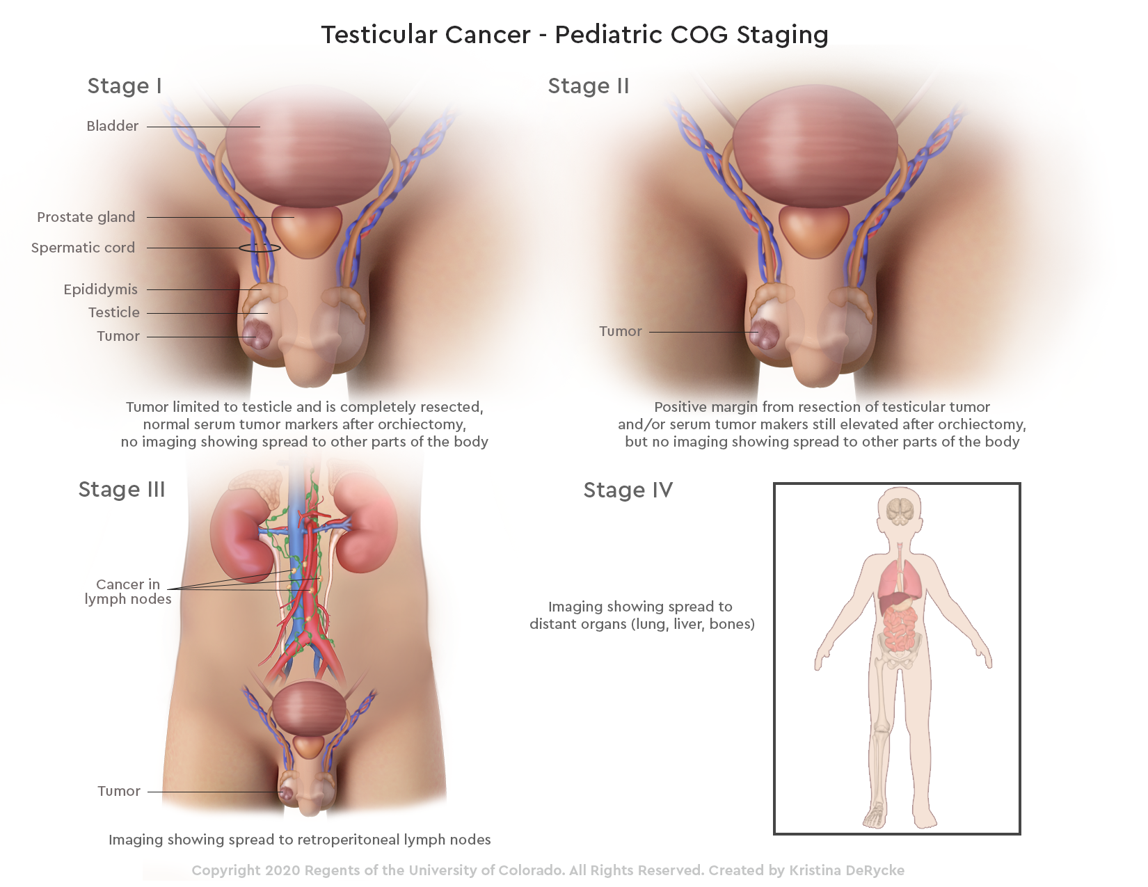 Testicular Cancer_Peds_image.png