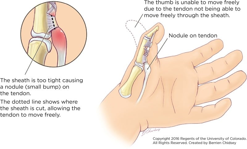 An artist's rendering of trigger thumb. The left side has a circle with a picture of a joint and tendon inside and the description below it says "The sheath is too tight causing a nodule (small bump) on the tendon. The dotted line shows where the sheath is cut, allowing the tendon to move freely." The right side is a picture of a hand with the bones and tendon shown inside the thumb and the description above it says "The thumb is unable to move freely due to the tendon not being able to move freely through the sheath."
