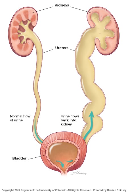 This illustration shows vesicoureteral reflux, which is the backflow of urine from the bladder to the kidneys through the ureters.