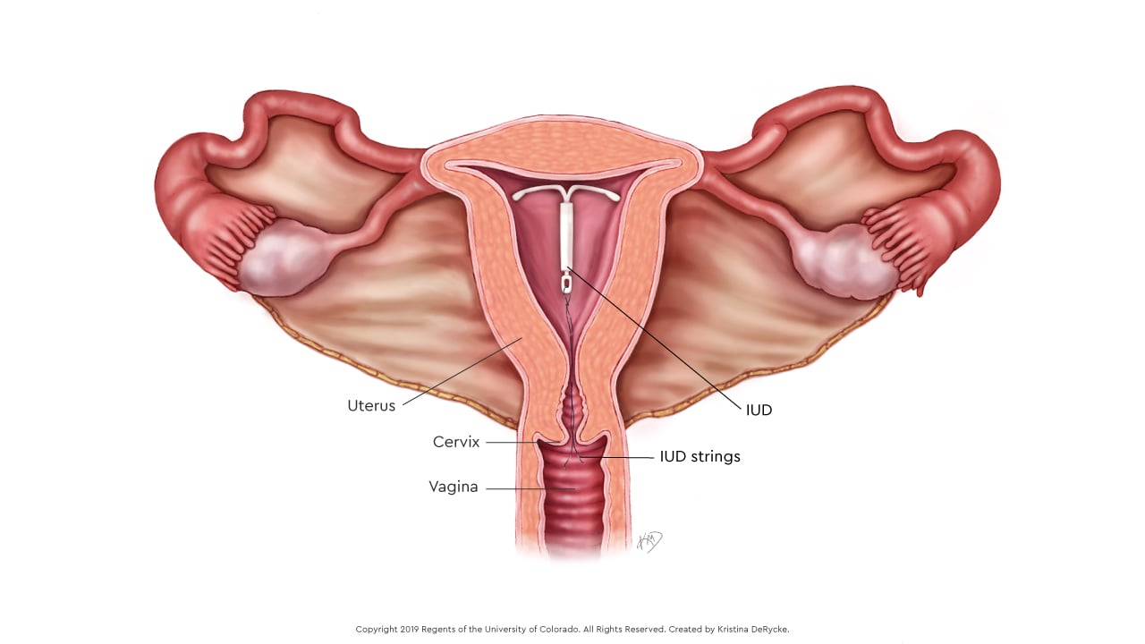 An illustration of what the IUD looks like after it’s been inserted into the uterus.