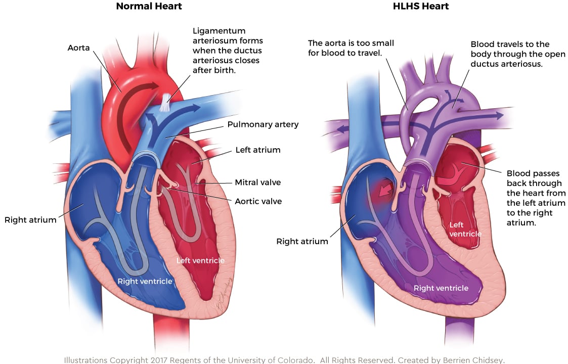 Graphic showing anatomy of a normal heart compared to the anatomy of an HLHS heart
