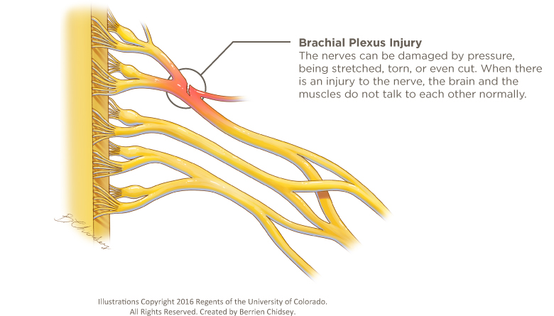 A close-up illustration of the nerves connecting the brain and arm muscles. It shows a red crack in one of the nerves where the brachial plexus injury exists. The notation says the nerves can be damaged by pressure, being stretched, torn, or even cut. When there is an injury to the nerve, the brain and the muscles do not talk to each other normally.