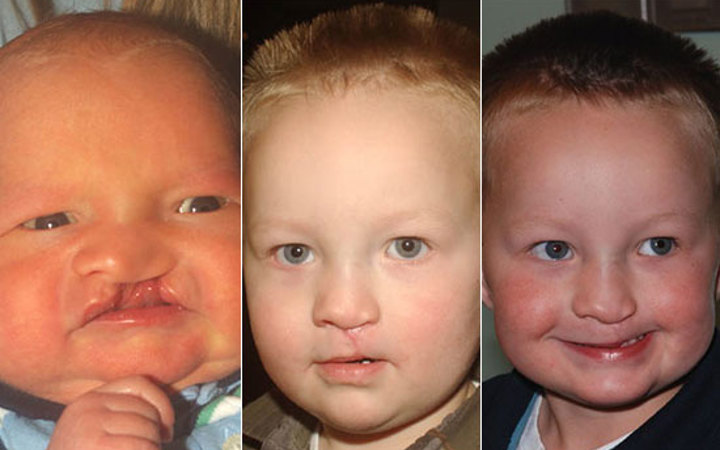Three close-up pictures of the same boy before and after cleft surgery. The first picture is before surgery as a baby. The second picture is as a toddler after surgery. The third picture is after the scar healed.