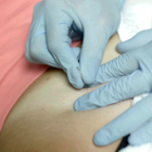 A specialist performs dry needling on an athlete. 