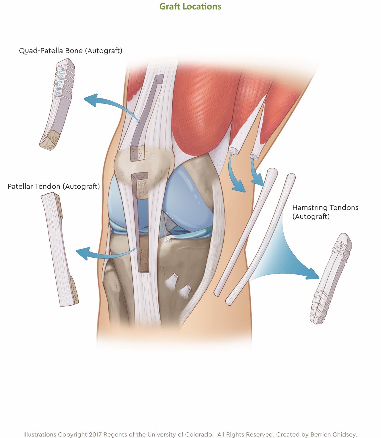 Illustration showing that an ACL graft can come from the quad-patella bone above the knee, the patellar tendon below the knee or the hamstring tendons on the side of the knee.