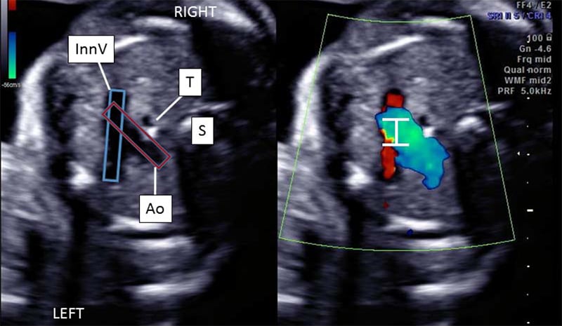 A black and white, axial 2D and color Doppler image of the fetal thorax demonstrating the position and relationship of the innominate vein (labeled InnV), the transverse aortic arch (labeled Ao), the trachea (labeled T) and the spine (labeled S). 