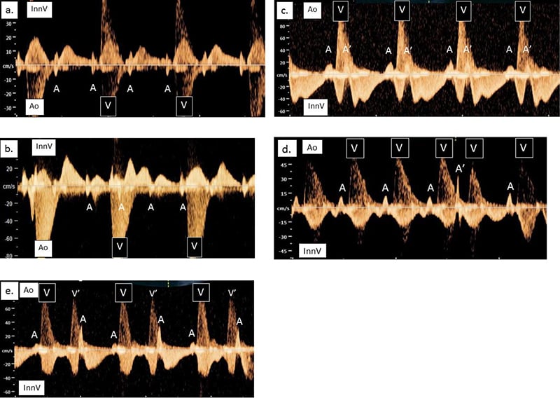 Five simultaneous recordings of the InnV and the Ao in different fetal arrhythmias. There are 5 graph-like images where there is a y-axis of cm/s labeled from -100 to 40 and yellowish waves along x-axis.