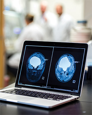 Craniopharyngioma MRI Scan shown on laptop