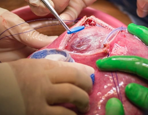 Surgeons perform an open fetal myelomeningocele repair as part of the their spina bifida research.