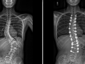Two x-rays showing before and after perioperative surgery