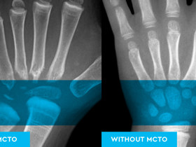 Two side-by-side X-ray images of hands. The one on the left has the label "With MCTO." The one on the right has the label "Without MCTO."