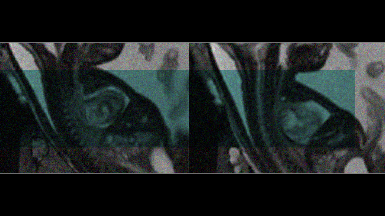Ultrasound images of fetus chest