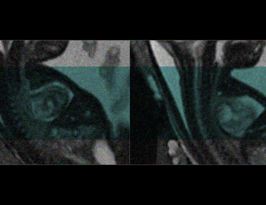 Ultrasound images of fetus chest
