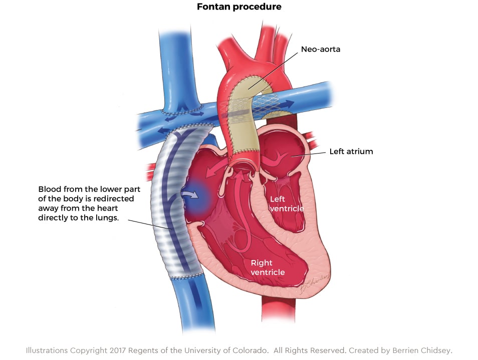 Graphic showing the Fontan procedure for HLHS
